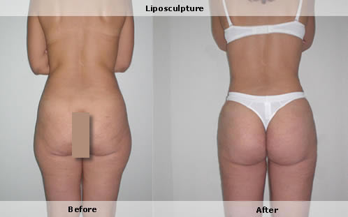 Liposuction,fat grafting for cellulite removal